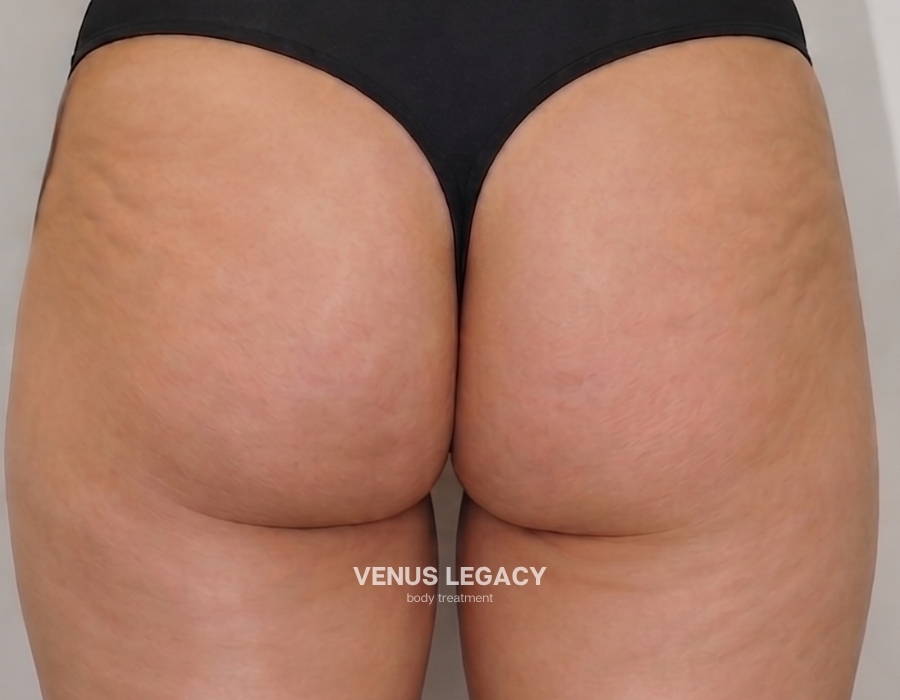buttock cellulite treatment venus legacy