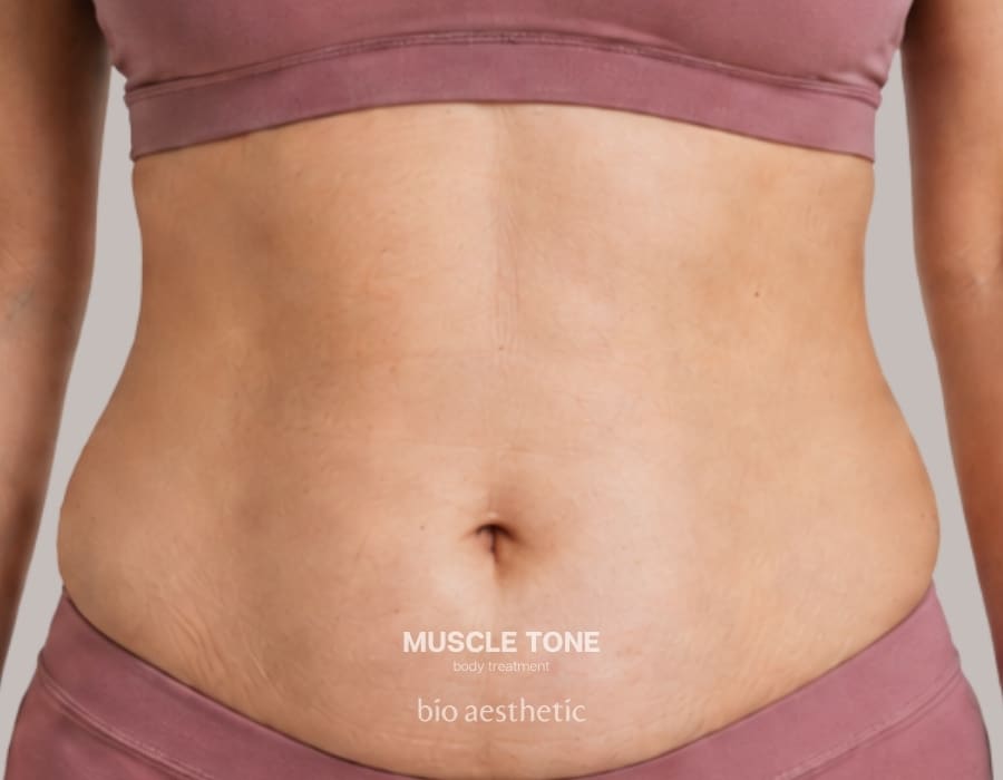 diastasis recti before and after muscle tone