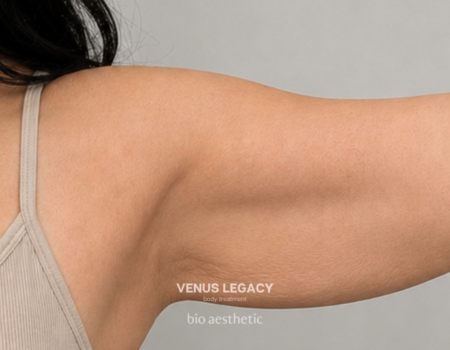 how to lose arm fat before and after venus legacy