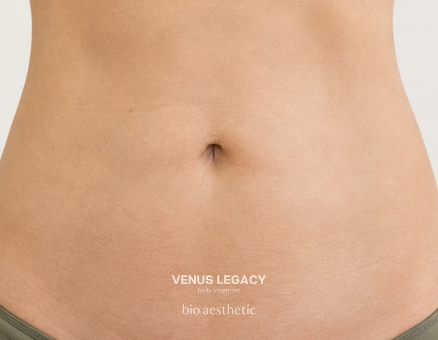 venus legacy skin tightening treatment before and after 1