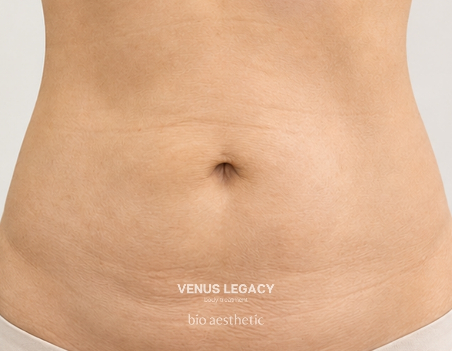 venus legacy skin tightening treatment before and after