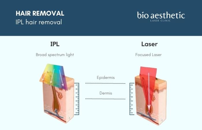 ipl hair removal device vs laser hair removal