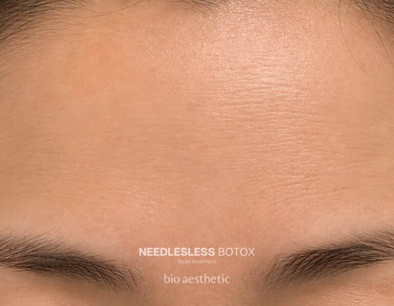 Fine lines after