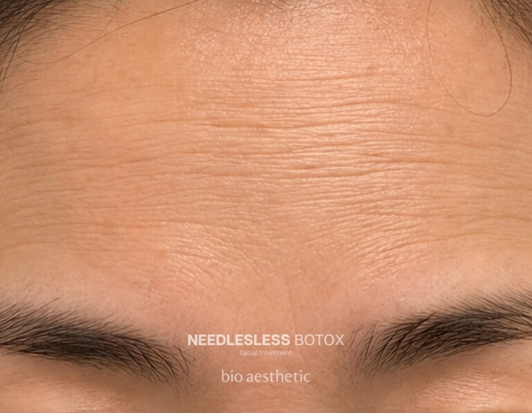Fine lines before