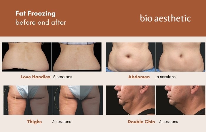 fat freezing before and after