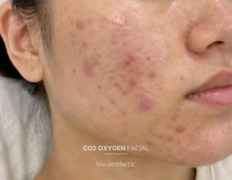Oily or combination skin before