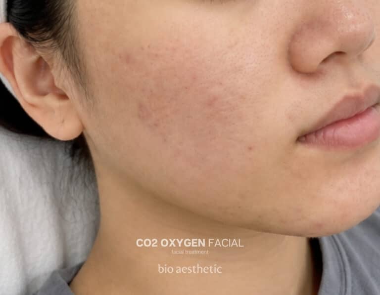 Oily or combination skin after