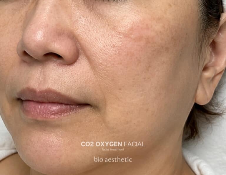 Dull skin before