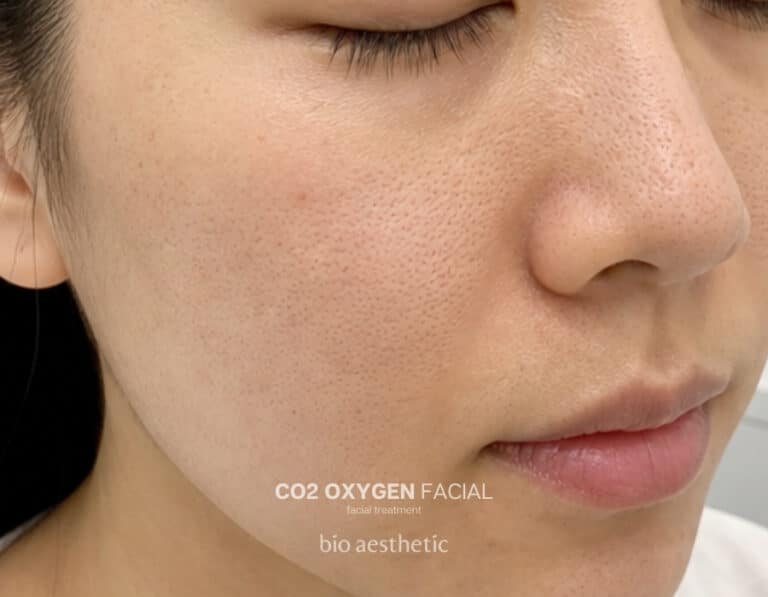 Enlarged looking pores before