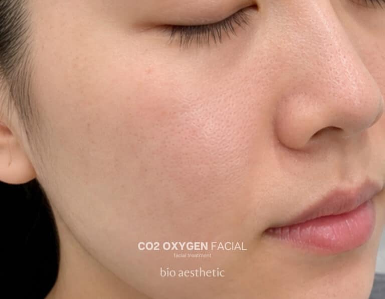 Enlarged looking pores after