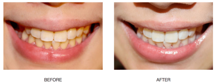 teeth whitening before and after 1