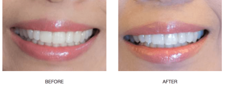 teeth whitening before and after 2