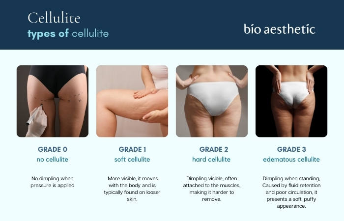 types of cellulite
