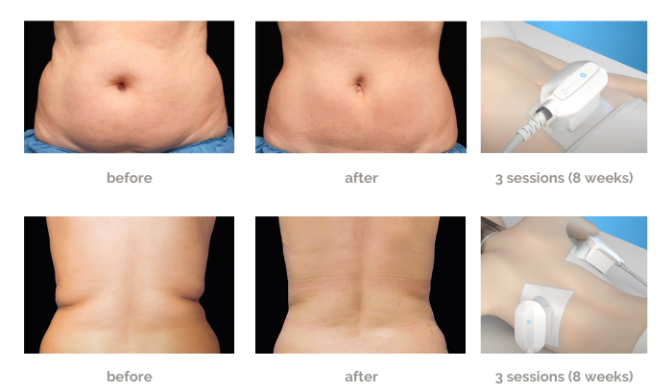 fat freezing before and after 1