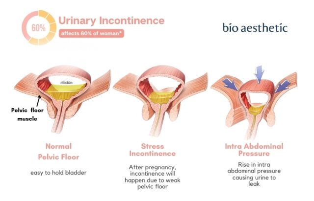 Urinary Incontinence Treatment - $99 Trial | Postpartum Specialist
