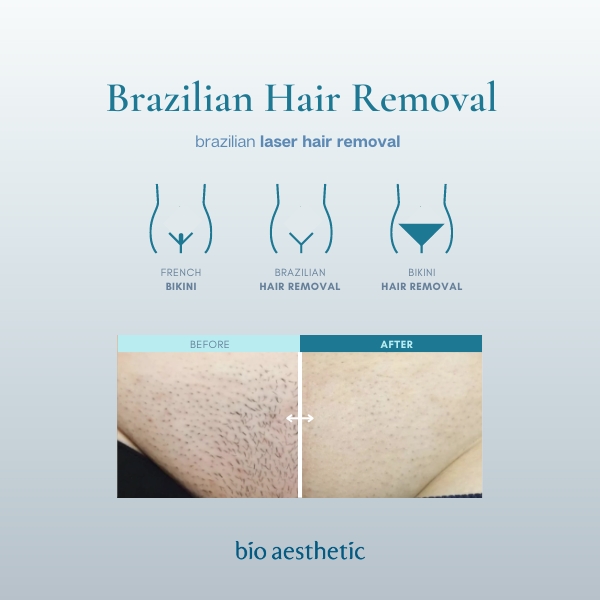 How Much Is Brazilian Laser Hair Removal Lovingshe