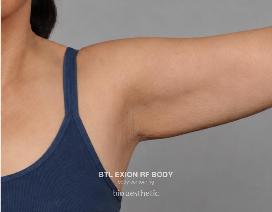 btl exion arm rf before and after 1
