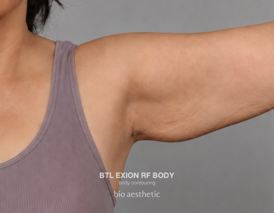 btl exion arm rf before and after