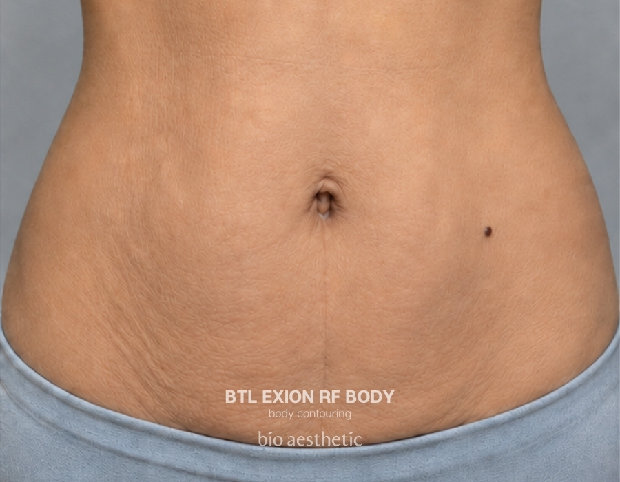 btl exion body rf before and after 1