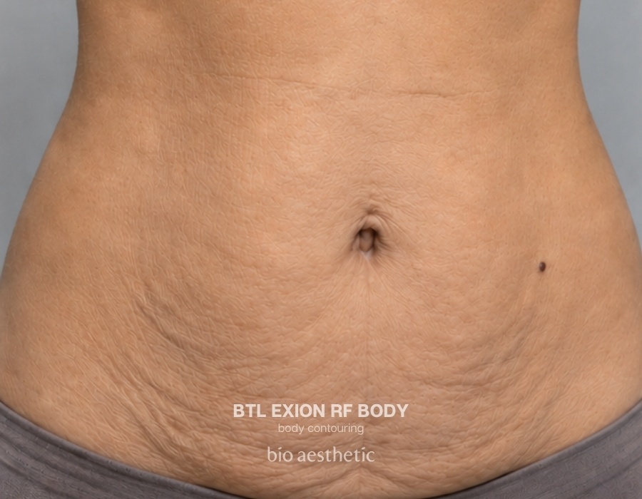 btl exion body rf before and after